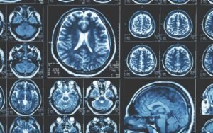 Kök Hücrelerle Beyin İyileşmesi: Felç ve İnme Sonrası Yeniden Ağı Oluşturma