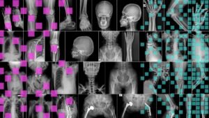 Radyolojide Yapay Zeka: Yükselen Umutlar ve Gerçek Engeller